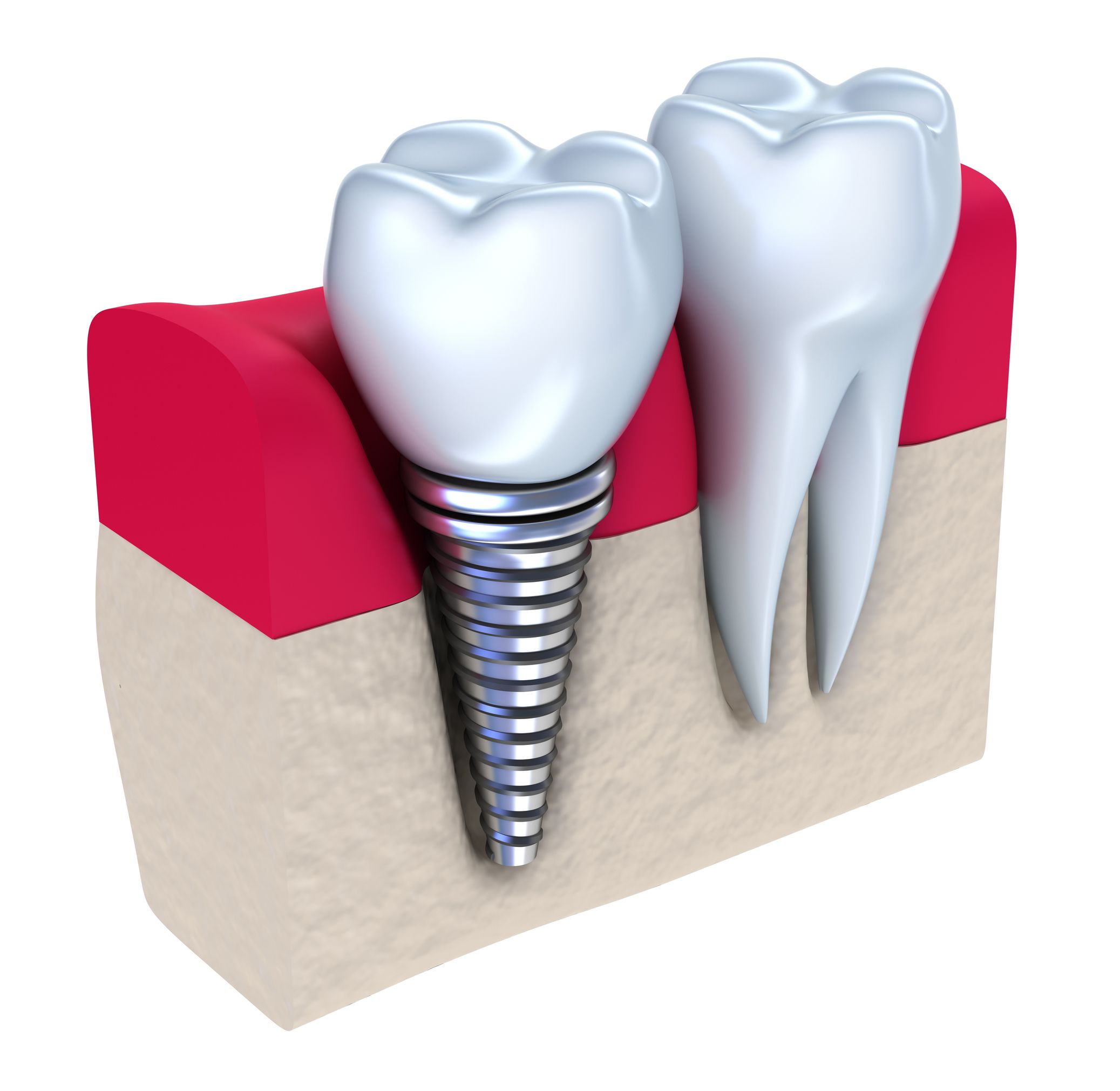 Dental Implants In Martin County MN Can Be A Great Way To Replace Lost Teeth