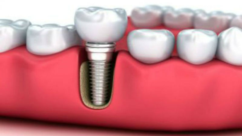 Comfortable & Reliable Dental Crowns When Working With a Trusted Lab