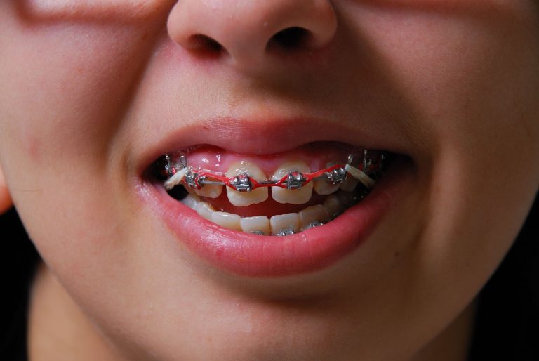 The Convenient Ways Orthodontics In Medina OH Can Save You Money